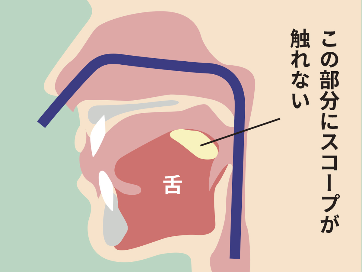 鼻からの胃カメラ検査
